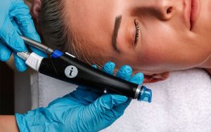 Unveiling the Benefits of Microneedling in Oakville