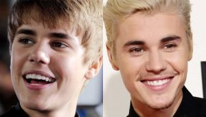 Celebrity Braces: From Invisalign to Ceramics