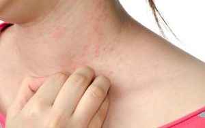 Finding Relief: The Importance of Eczema Clothing in Managing Skin Conditions