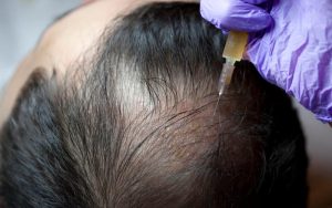 The Benefits of PRP Hair Treatment: A Revolutionary Solution for Hair Loss