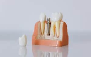 Enhancing Patient Care with Advanced Dental Prosthetics