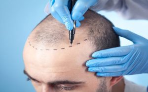 The Importance of Initial Consultations Before Follicle Implantations in Sydney