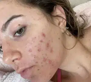 Reasons Why PanOxyl Pimple Patch Products Might Not Work