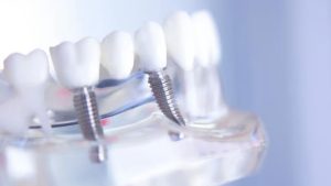Comprehensive Guide to Dental Implants: Achieve a Healthy, Confident Smile