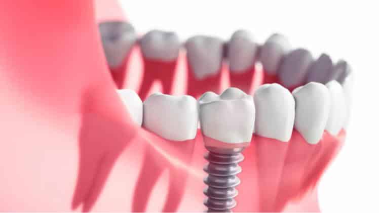 Dental Implants
