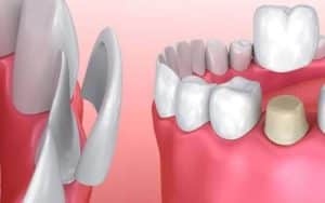 Dental Veneers vs. Crowns: Key Factors to Consider