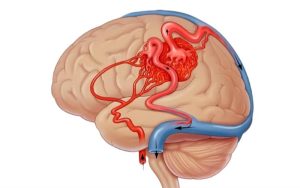 Understanding AVM Rupture: Causes, Symptoms, and Advanced Treatment Options