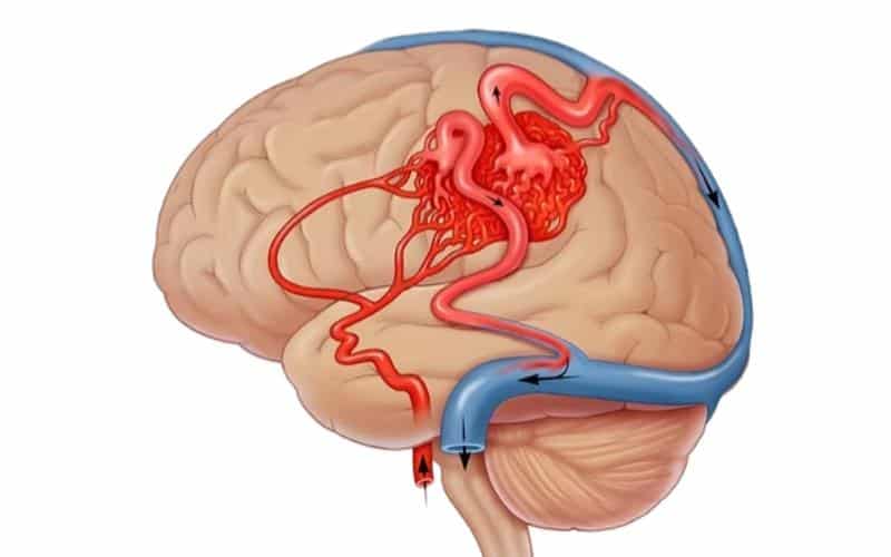 Understanding AVM Rupture Causes, Symptoms, and Advanced Treatment Options