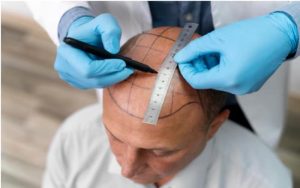 Understanding the Cost of a Hair Transplant: A Look into the FUE Procedure