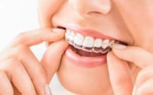 Invisalign: Revolutionizing Modern Orthodontics