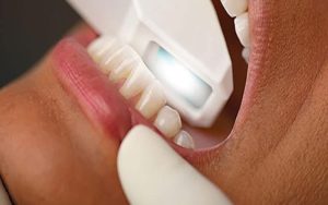 The Future of Orthodontic Precision: Digital Solutions