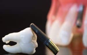 What Are the Best Drivers for Dental Implants?