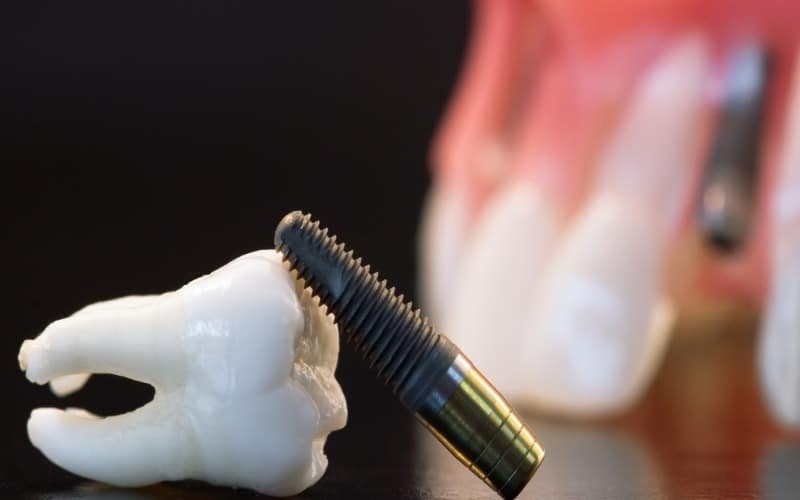 What Are the Best Drivers for Dental Implants?