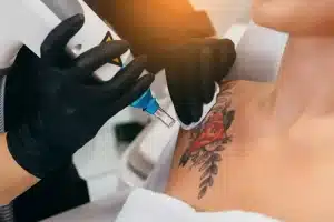 Your Step-by-Step Guide on How to Remove a Tattoo